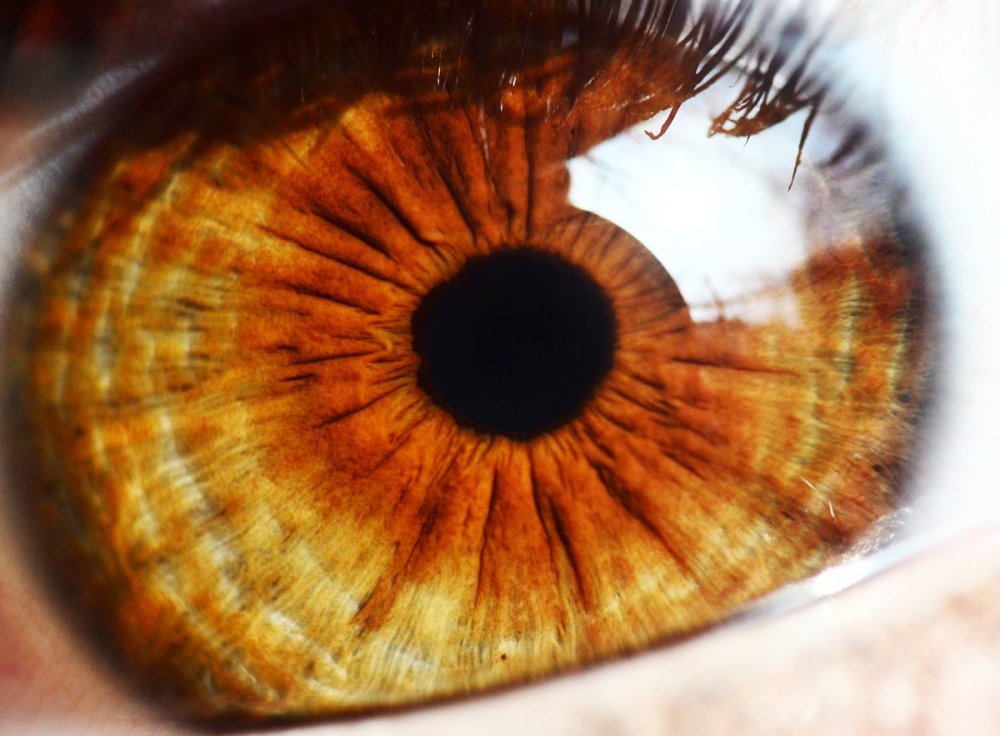 Гетерохромия Радужки глаз