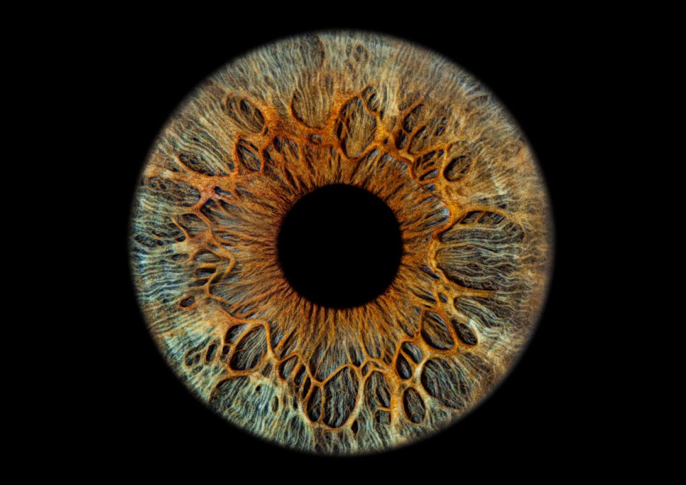 Субатрофичная радужка