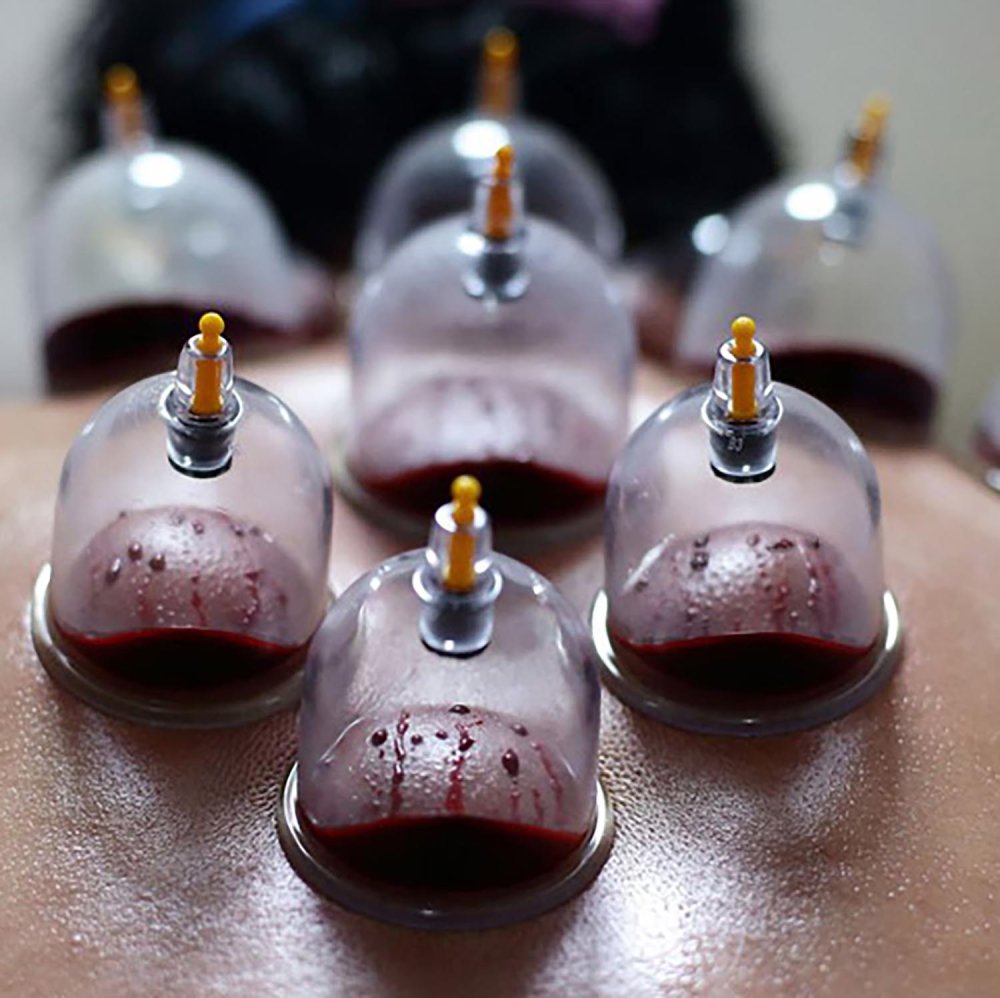 Кровопускание банками хиджама