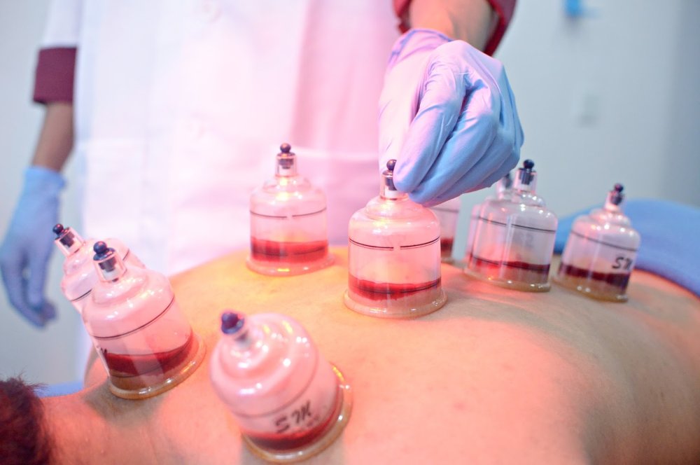 Каппинг терапия кровопускание