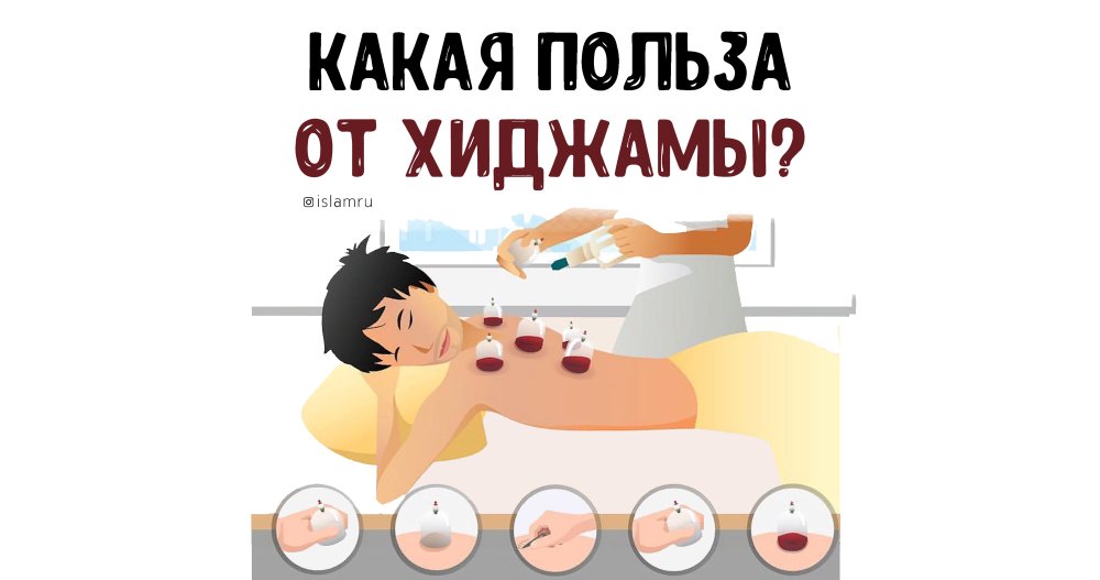 Капиллярное кровопускание хиджама