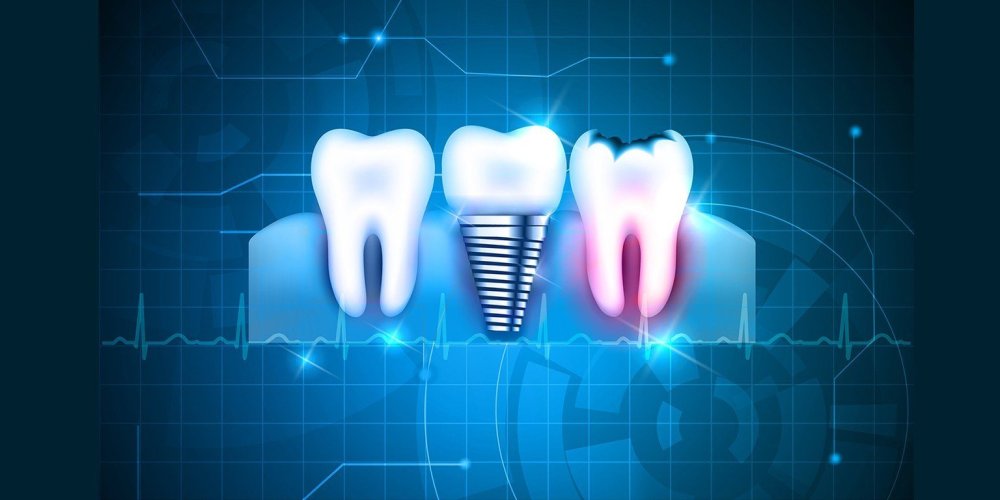 Зуб абстракция