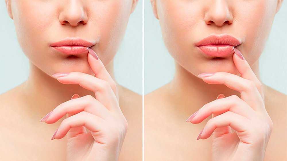 Plump Botox Lips