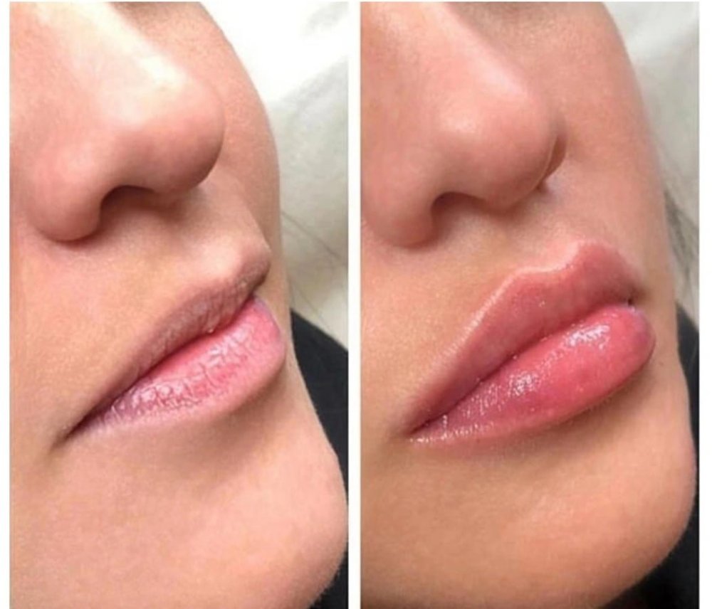 Мезотерапия губ гиалуроновой кислотой