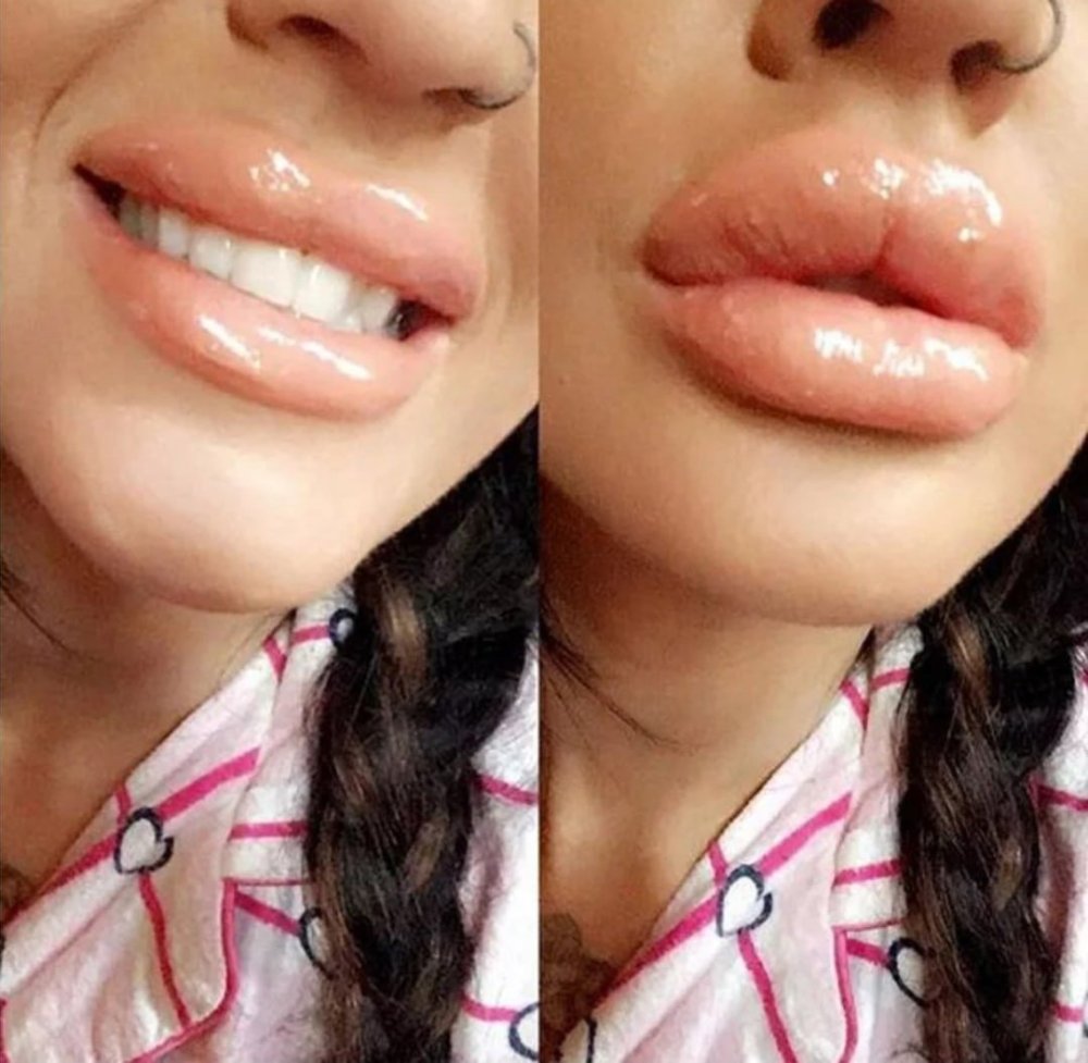 Увеличенные губы красивые