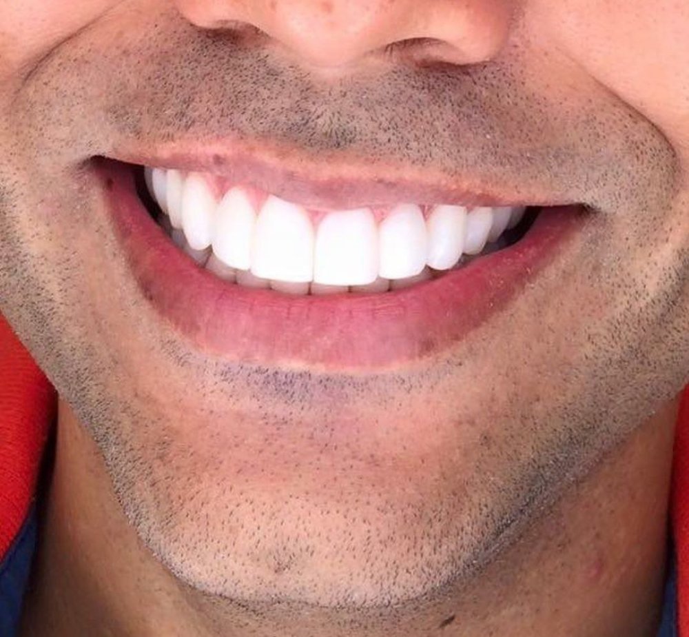 Красивые зубы мужские